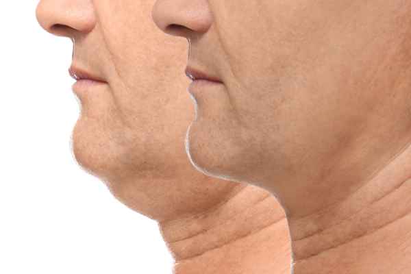HIFU - Breakthrough in Anti - ageing 2 hifu results Harrogate