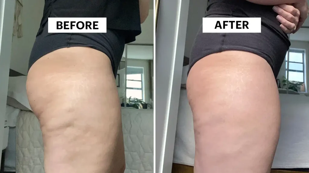 Sculpting Your Bum: Can Toning Exercises Really Reduce Cellulite? 1 Do Toning Exercise Harrogate Really Tackle Cellulite?