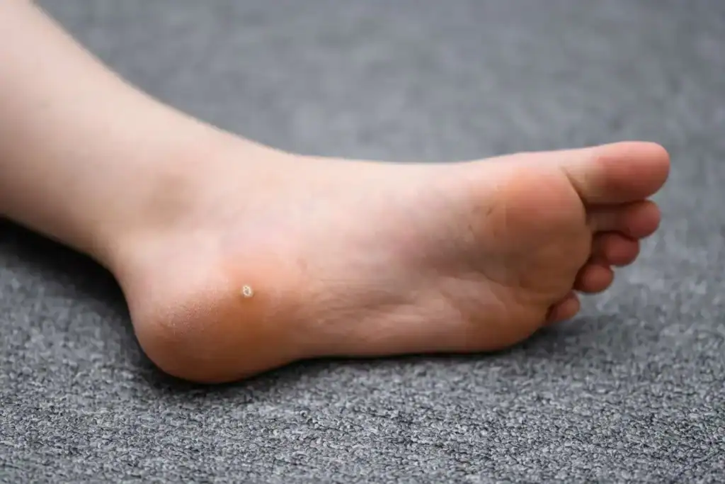 Cryotherapy For Warts And Also Verrucas 2 Image of verruca on the bottom of the foot that able to be treated with Cryotherapy Harrogate