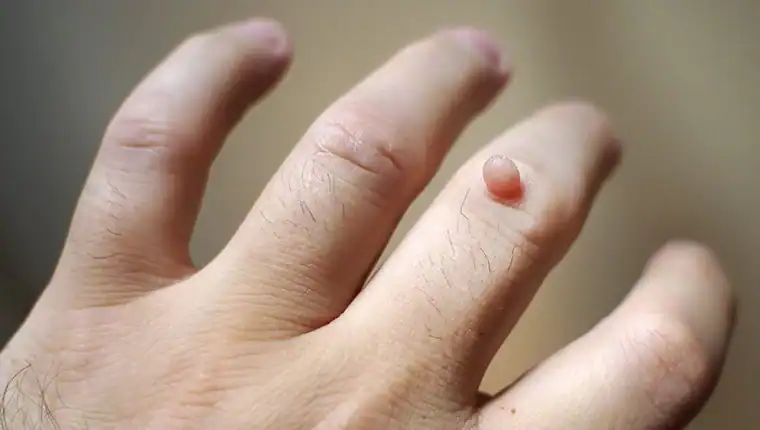 Image of blemish that Cryotherapy Harrogate can remove with Lipo 360.