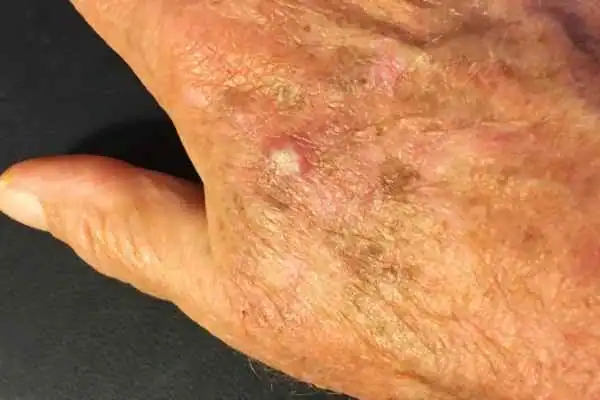 Image of Actinic keratoses Harrogate on a person hand