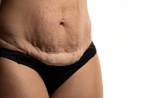 The science behind skin tightening Harrogate picture of a woman's sagging skin on the stomach